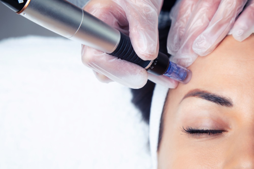 Microneedling pen treatment refining skin texture
