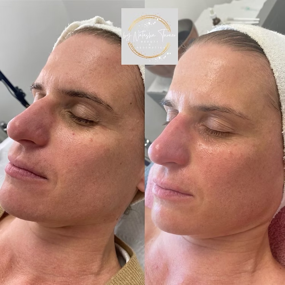 Skin before and after Lynton IPL skin rejuvenation at the clinic
